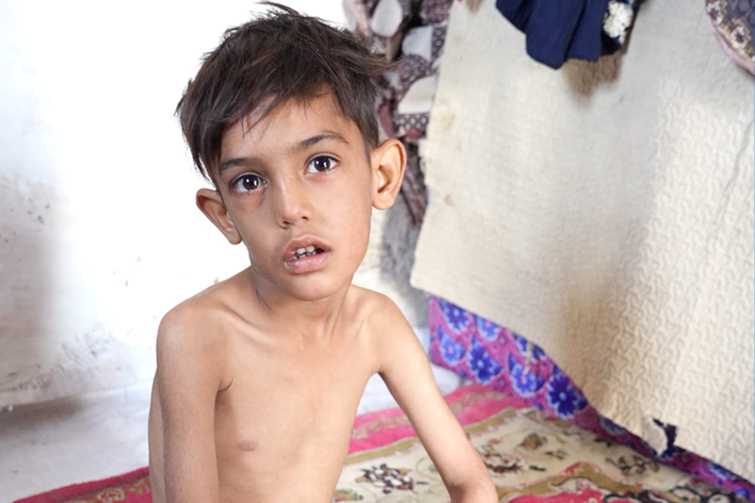 Save Little Yasin | Malnourished Child 