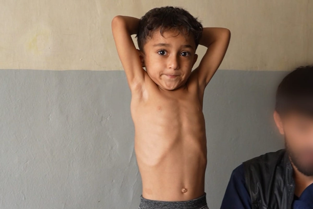 Hope for Malnourished Kaihan. 1