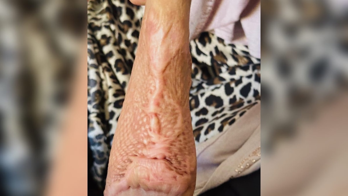 Help for Maryam 6 years old for her burned hand. 1