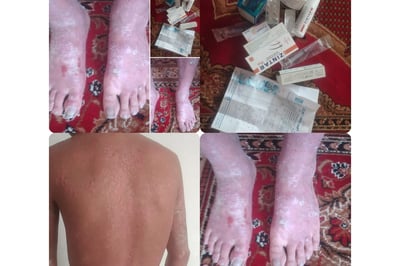 Support Faisal's Rare Skin Disease treatment